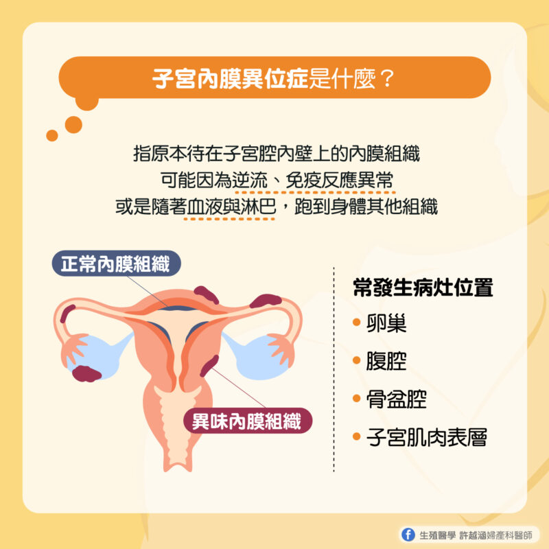 什麼是子宮內膜異位症? - 生殖醫學｜ 許越涵婦產科醫師